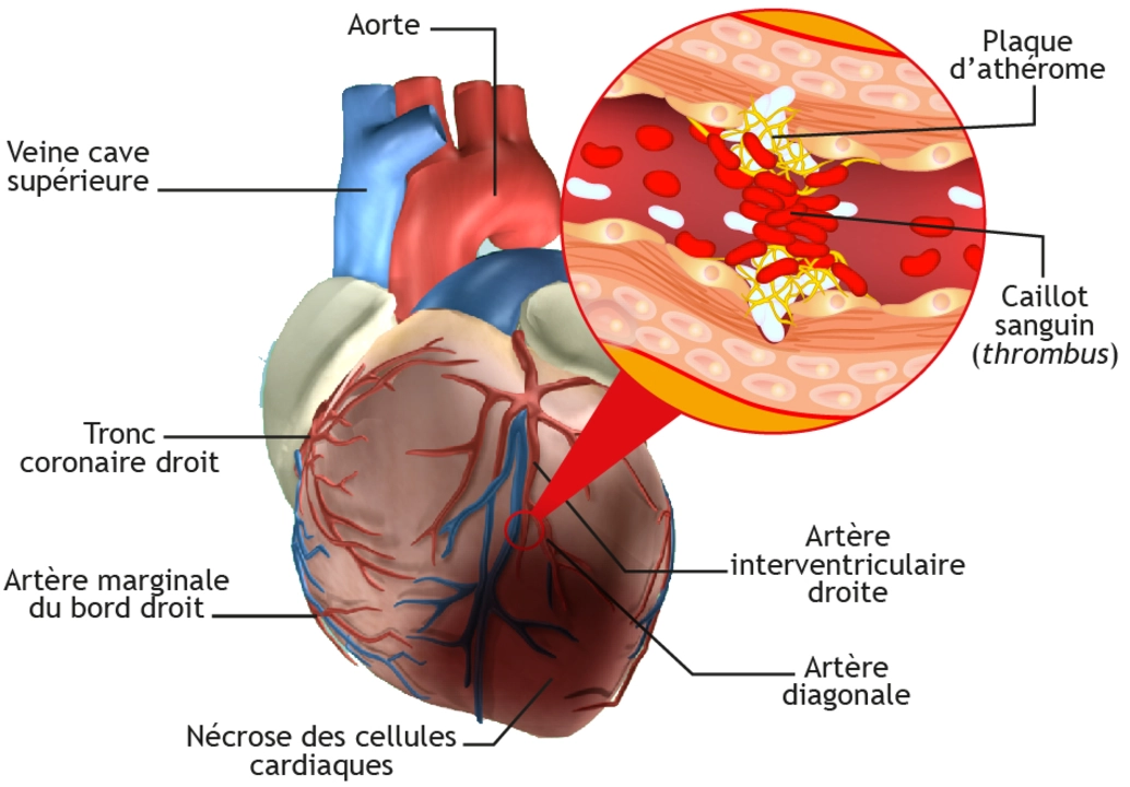 Moxifloxacine et le cœur : Risques cardiaques potentiels